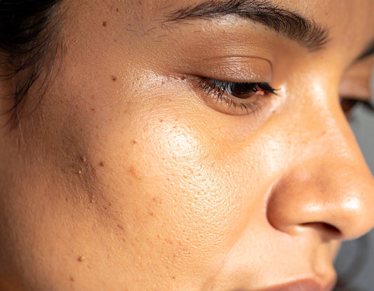 Why You Should Apply Sunscreen Daily — Even If You Have Melanin-Rich Skin