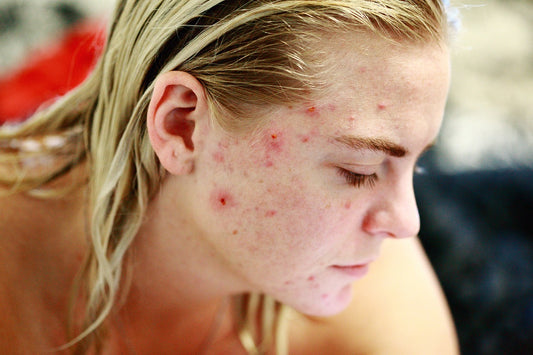 A Holistic Approach to Acne: Mind, Body, and Skin